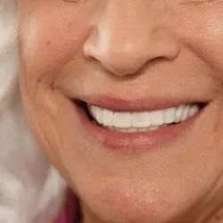 لمینت دندان دو فک مدل TruSmile (اورجینال)